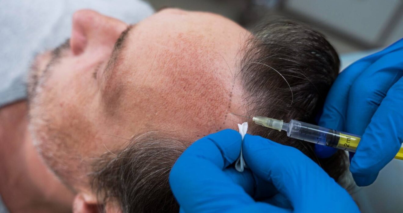 Best Hair Loss Treatment in Noida