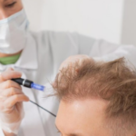 Hair Fall Treatment Doctor in Noida